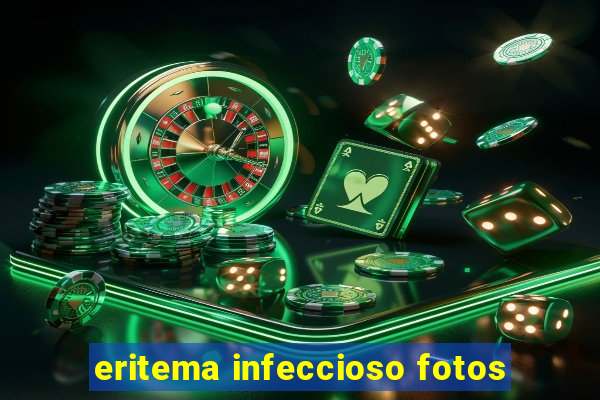 eritema infeccioso fotos
